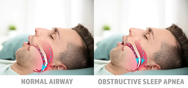Reasons for Snoring Every Night? When Snoring Could Be a Sign of Sleep Apnea